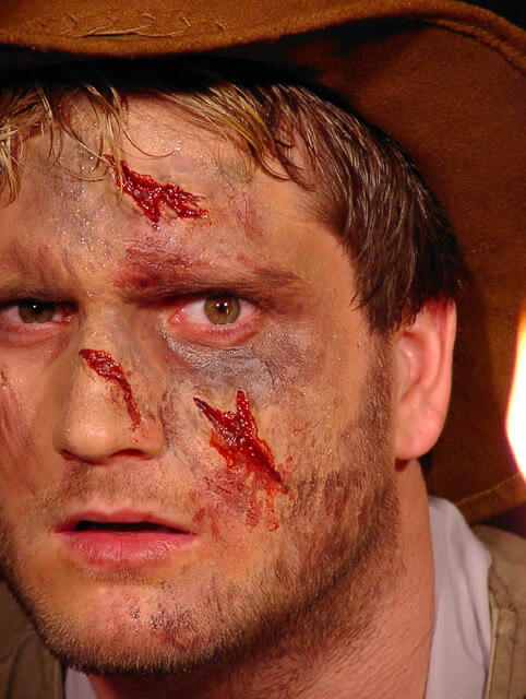 Prosthetic Wounds Dirty Scars